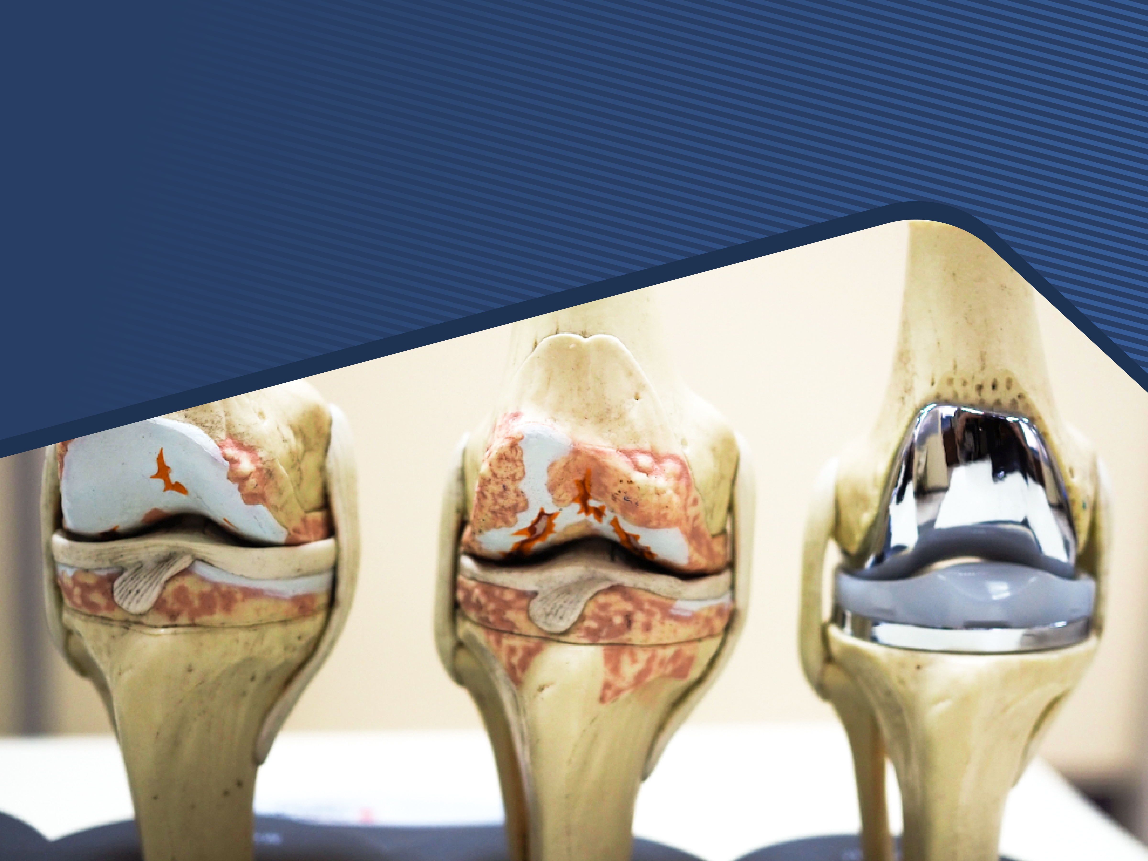 Saiba como funciona a prótese total de joelho
