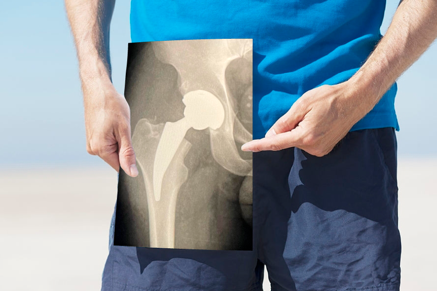 Prótese do quadril em jovens: é preciso esperar?