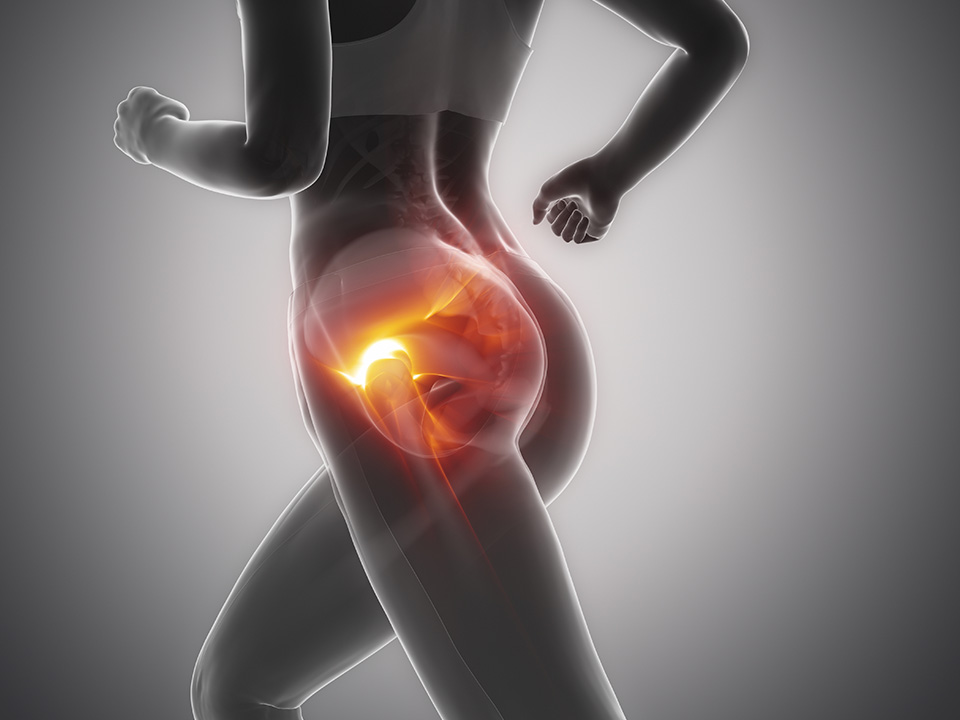 Osteonecrose da cabeça femoral: Causas, sintomas e mais